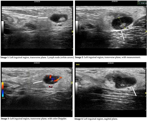 inguinal lymphadenopathy ultrasound